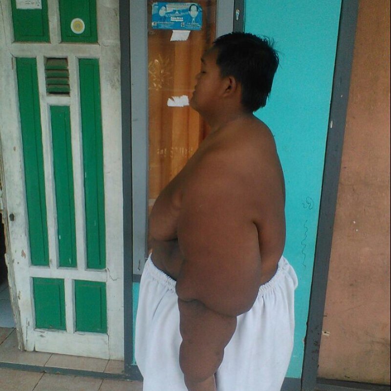 Самый толстый ребенок в мире похудел более чем на 100 килограмм (11 фото)