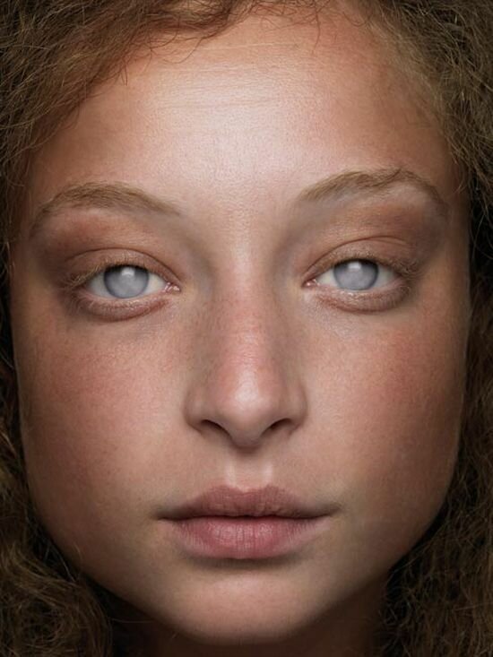 20 прекрасных генетических мутаций у людей (21 фото)