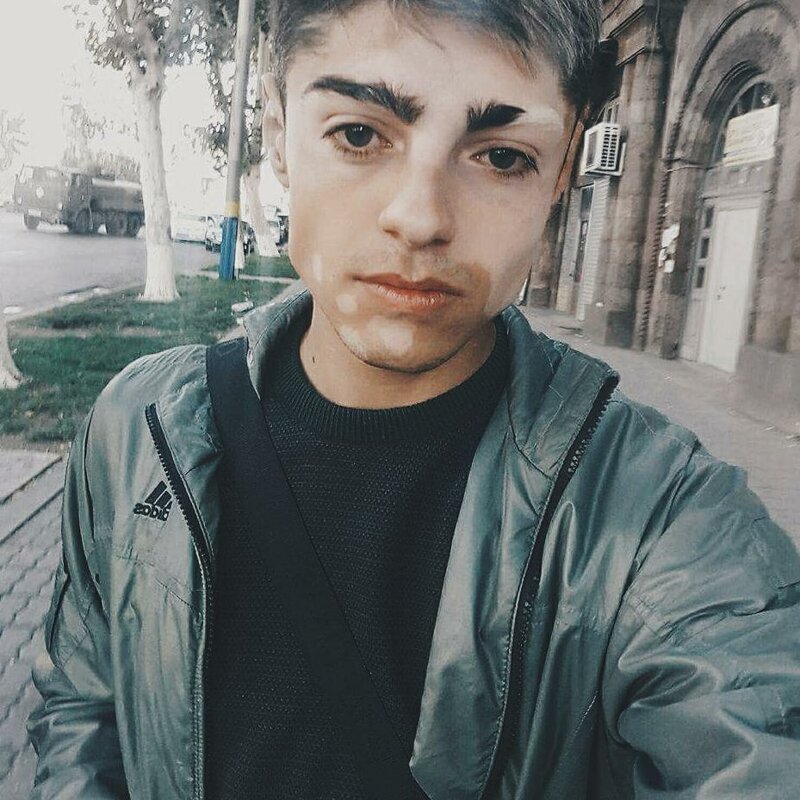 20 прекрасных генетических мутаций у людей (21 фото)