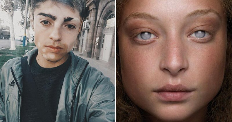 20 прекрасных генетических мутаций у людей (21 фото)