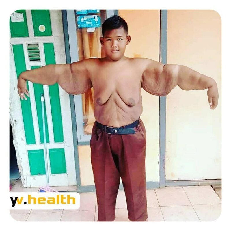 Самый толстый ребенок в мире похудел более чем на 100 килограмм (11 фото)