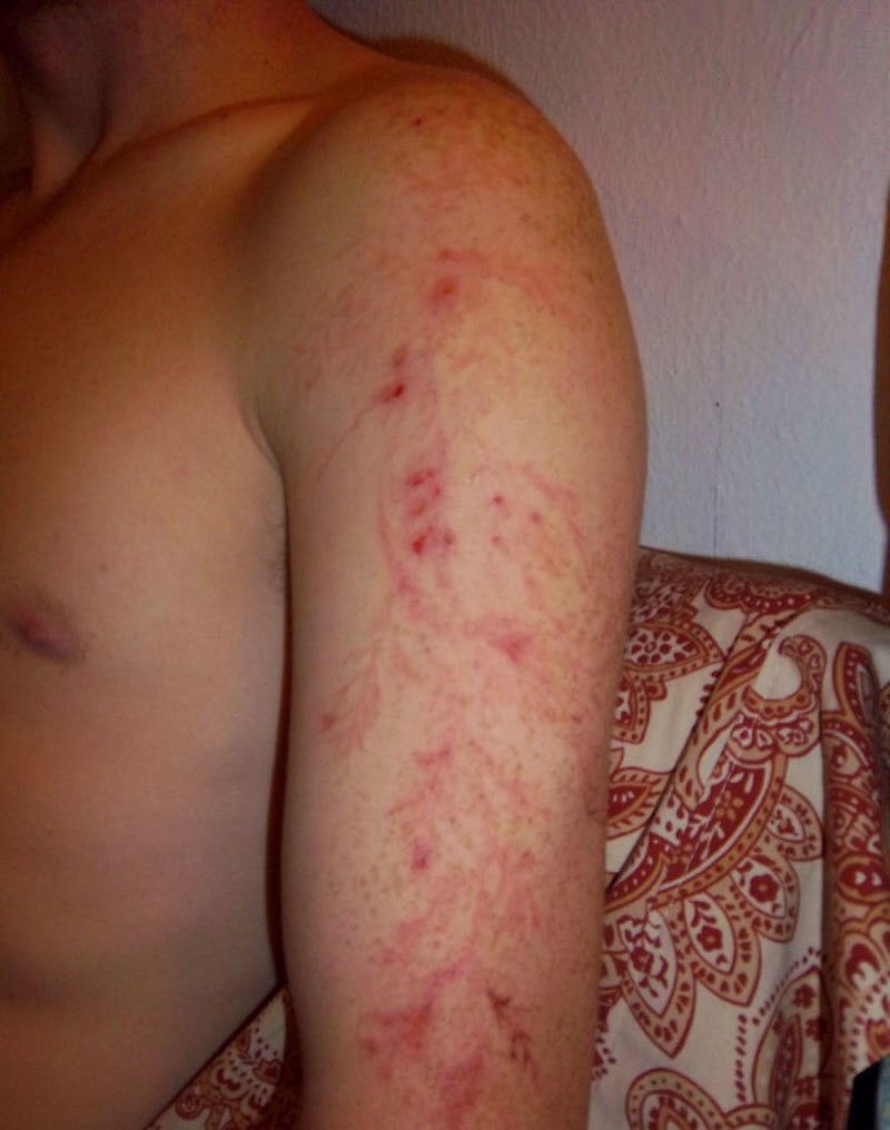 После разряда: что происходит с человеком, в которого ударила молния (16 фото) После разряда: что происходит с человеком, в которого ударила молния (16 фото)