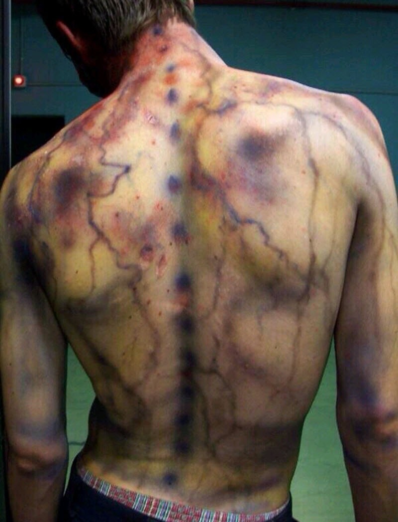 После разряда: что происходит с человеком, в которого ударила молния (16 фото) После разряда: что происходит с человеком, в которого ударила молния (16 фото)