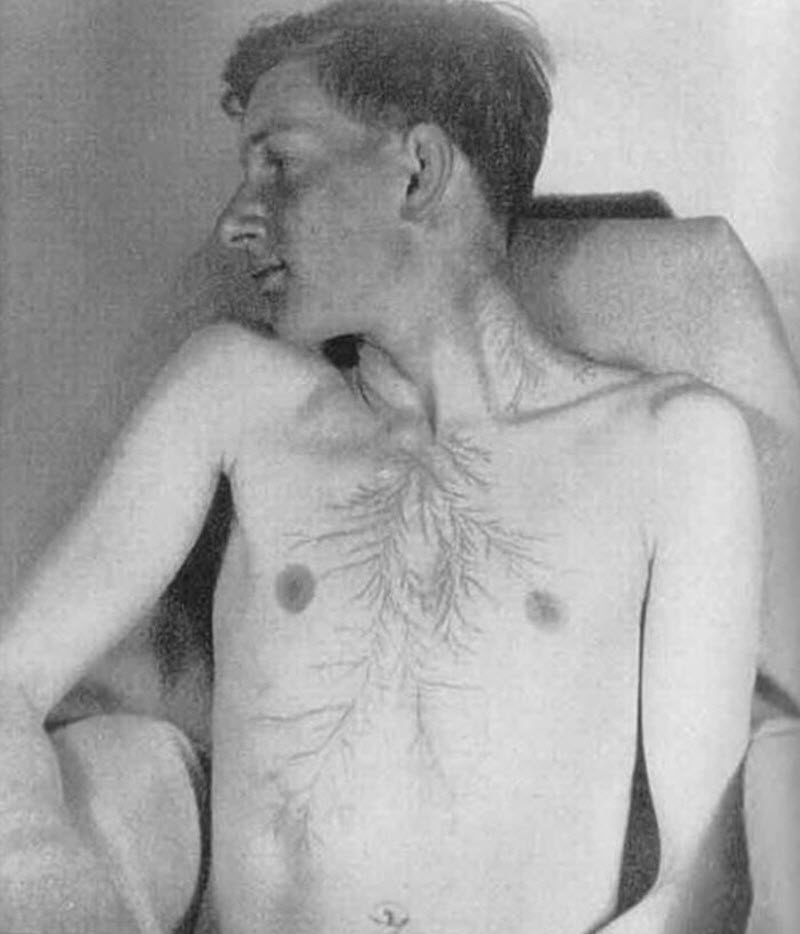 После разряда: что происходит с человеком, в которого ударила молния (16 фото) После разряда: что происходит с человеком, в которого ударила молния (16 фото)