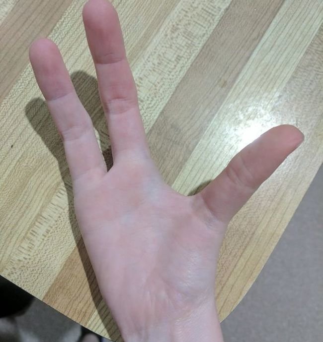 Не мутанты, а люди с редкими генетическими аномалиями (12 фото)