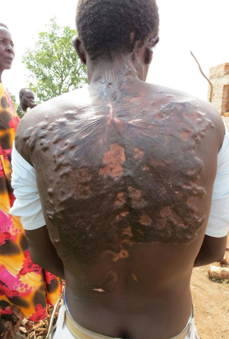 После разряда: что происходит с человеком, в которого ударила молния (16 фото) После разряда: что происходит с человеком, в которого ударила молния (16 фото)