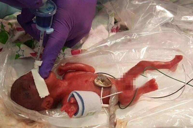 Самая маленькая новорожденная в мире была размером с яблоко (7 фото) Самая маленькая новорожденная в мире была размером с яблоко (7 фото)