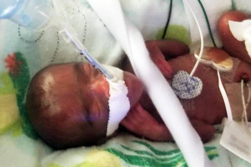 Самая маленькая новорожденная в мире была размером с яблоко (7 фото) Самая маленькая новорожденная в мире была размером с яблоко (7 фото)