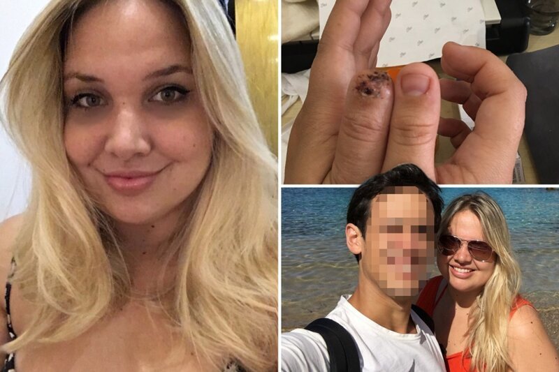 Парень откусил подруге палец из-за ночного кошмара (8 фото)