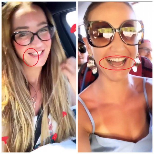 Улыбка на 100 рублей. Бузова ужаснула фанатов дырявыми и гнилыми зубами 