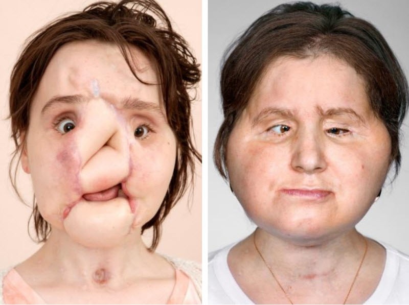 Шокирующая история надежды: после неудачной попытки самоубийства девушка получила новое лицо (15 фото) Шокирующая история надежды: после неудачной попытки самоубийства девушка получила новое лицо (15 фото)