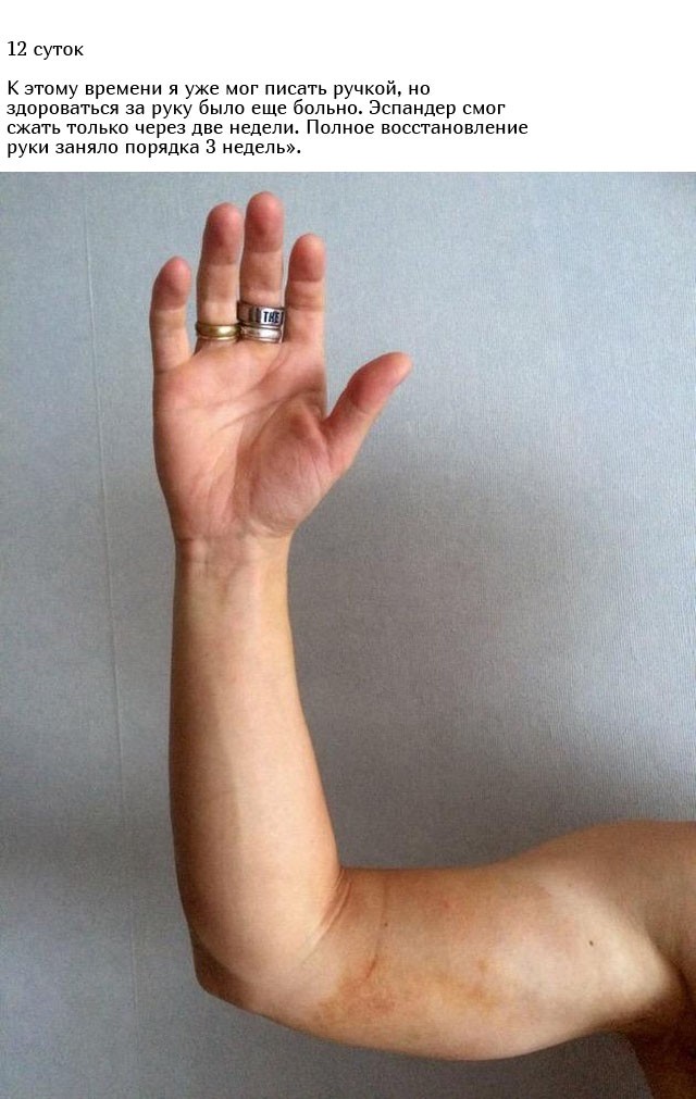 Укус гадюки из первых уст (12 фото)