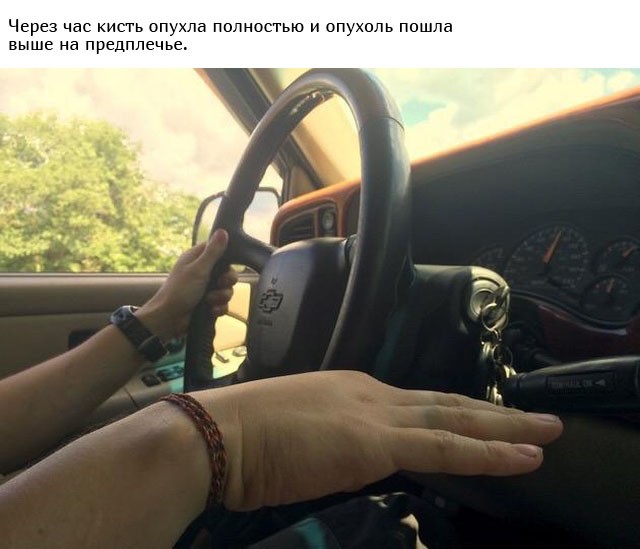 Укус гадюки из первых уст (12 фото)