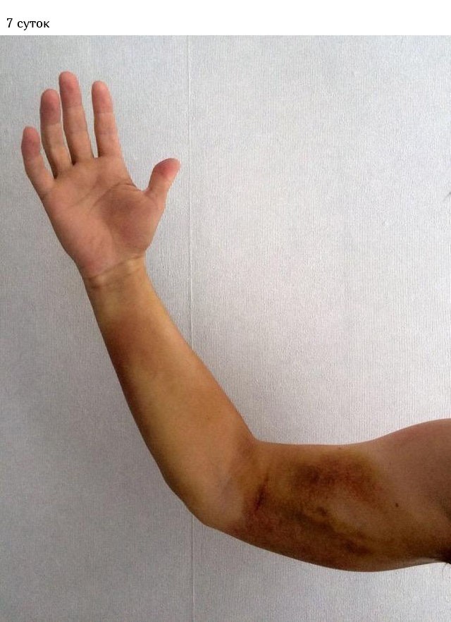 Укус гадюки из первых уст (12 фото)