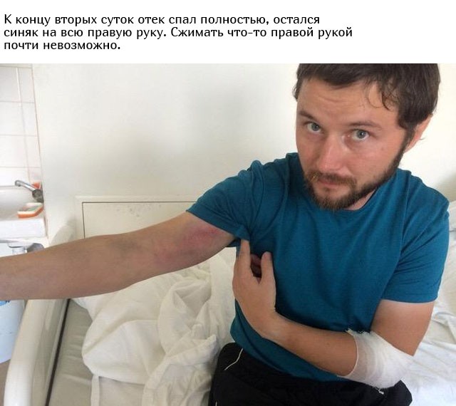 Укус гадюки из первых уст (12 фото)