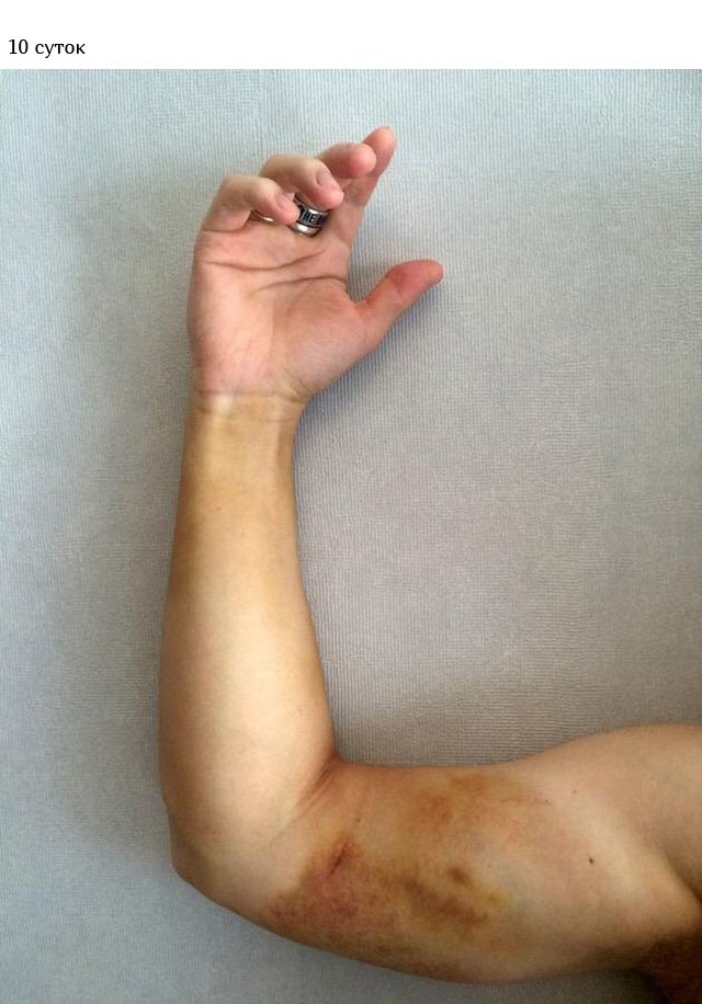 Укус гадюки из первых уст (12 фото)