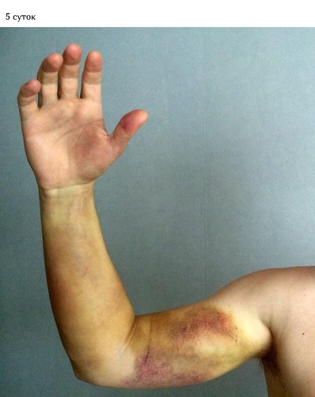 Укус гадюки из первых уст (12 фото)