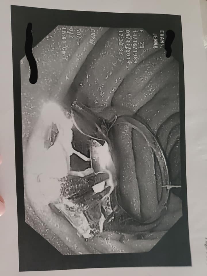 Девушке приснилось, будто она проглотила свое кольцо. Наутро сон оказался реальностью (11 фото)