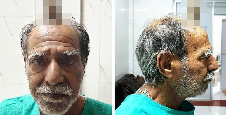 74-летнему индийцу удалили 10-сантиметровый "дьявольский рог" (6 фото) 74-летнему индийцу удалили 10-сантиметровый "дьявольский рог" (6 фото)