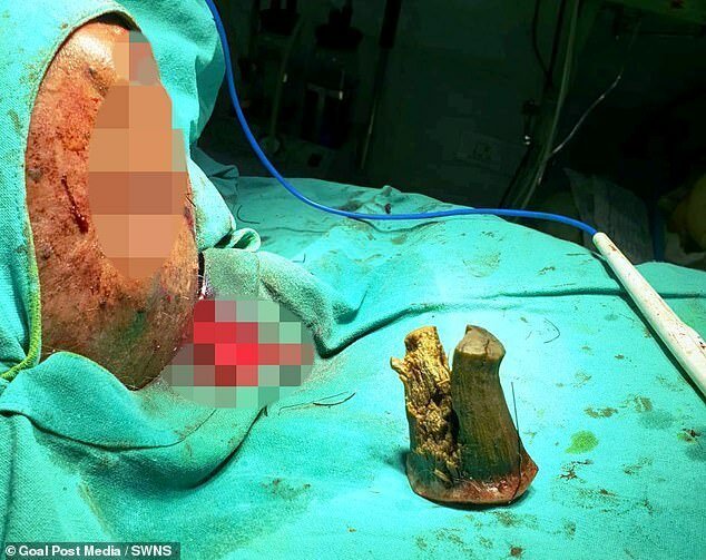 74-летнему индийцу удалили 10-сантиметровый "дьявольский рог" (6 фото) 74-летнему индийцу удалили 10-сантиметровый "дьявольский рог" (6 фото)