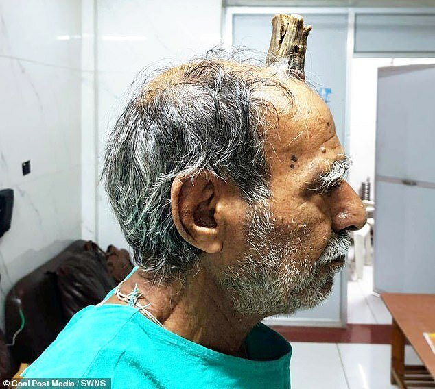 74-летнему индийцу удалили 10-сантиметровый "дьявольский рог" (6 фото) 74-летнему индийцу удалили 10-сантиметровый "дьявольский рог" (6 фото)