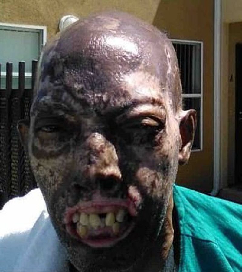 Первый чернокожий человек с донорским лицом (9 фото)