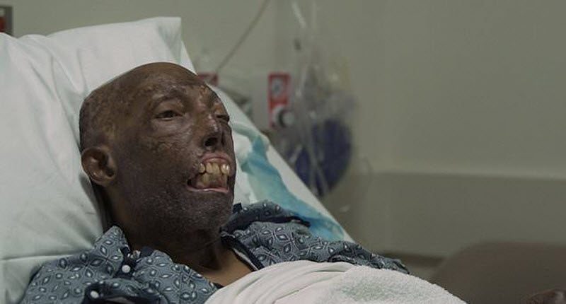 Первый чернокожий человек с донорским лицом (9 фото)