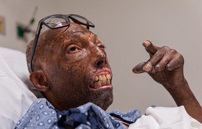 Первый чернокожий человек с донорским лицом (9 фото)