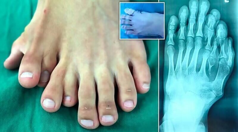 В Китае врачи прооперировали юношу с 9 пальцами на одной ноге (8 фото + 1 видео) В Китае врачи прооперировали юношу с 9 пальцами на одной ноге (8 фото + 1 видео)