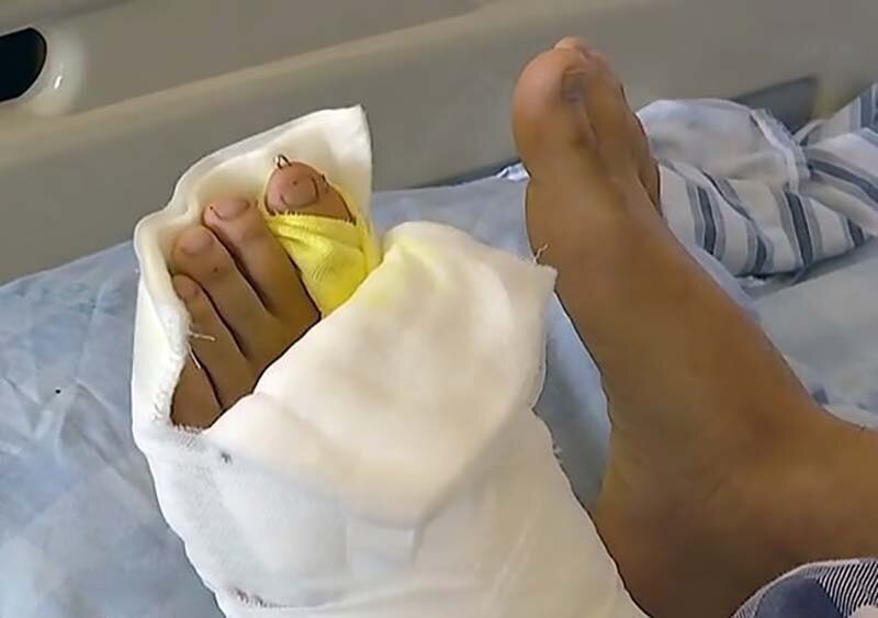 В Китае врачи прооперировали юношу с 9 пальцами на одной ноге (8 фото + 1 видео) В Китае врачи прооперировали юношу с 9 пальцами на одной ноге (8 фото + 1 видео)