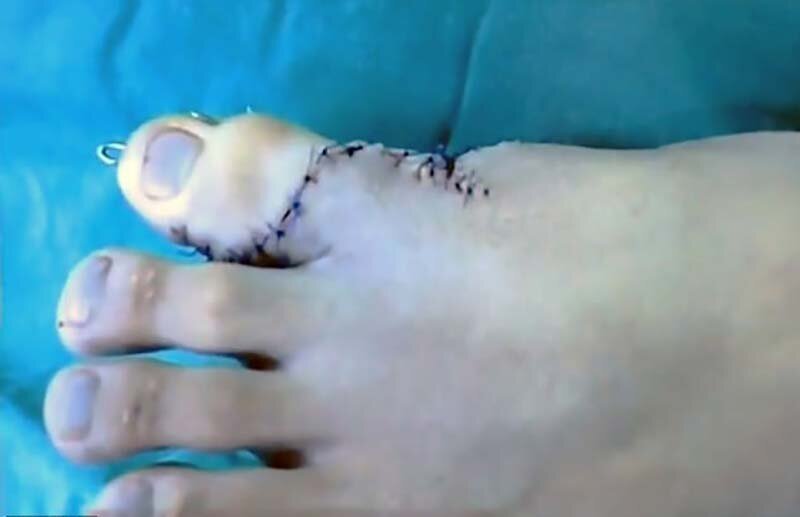 В Китае врачи прооперировали юношу с 9 пальцами на одной ноге (8 фото + 1 видео) В Китае врачи прооперировали юношу с 9 пальцами на одной ноге (8 фото + 1 видео)