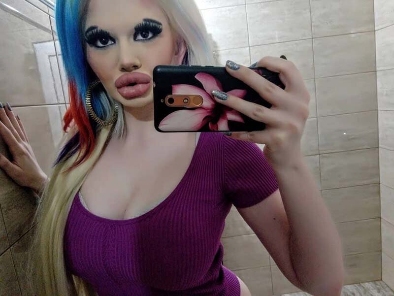 Девушка изменила размер своих губ с помощью 15 хирургических процедур (6 фото) Девушка изменила размер своих губ с помощью 15 хирургических процедур (6 фото)