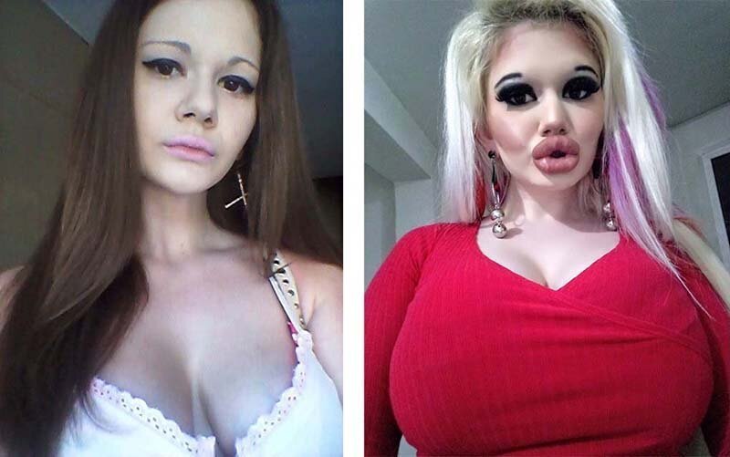 Девушка изменила размер своих губ с помощью 15 хирургических процедур (6 фото) Девушка изменила размер своих губ с помощью 15 хирургических процедур (6 фото)