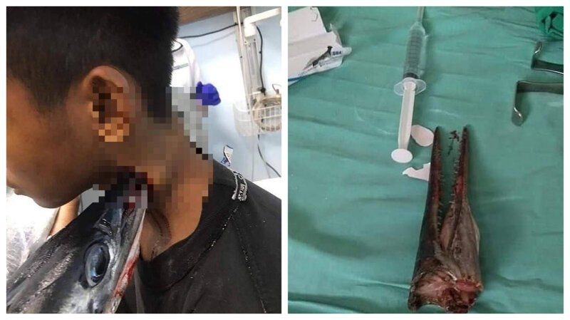 Рыба-игла пронзила мальчику шею насквозь (5 фото)