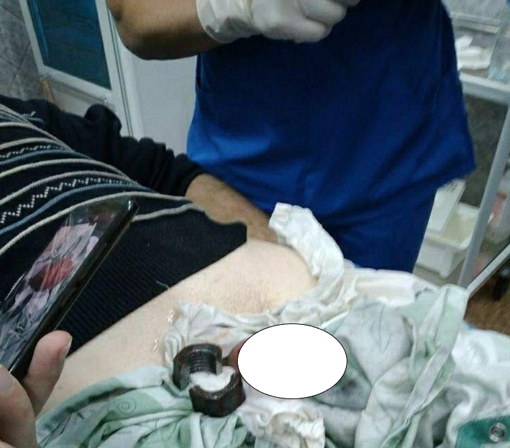 В Запорожье обиженная жена надела гайку на пенис мужа, отомстив ему за измену (4 фото + 1 видео)