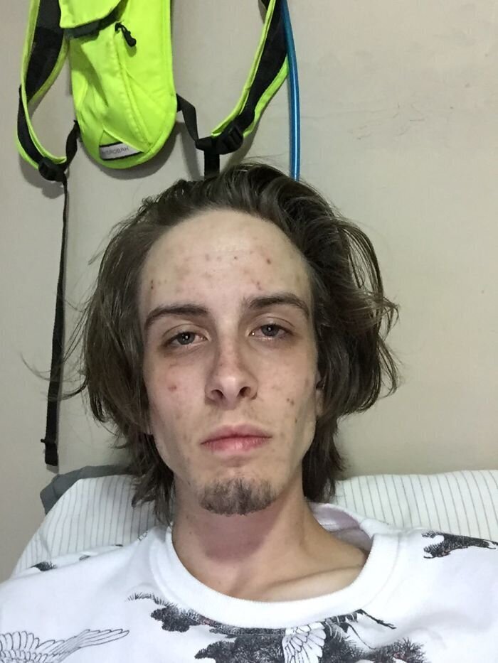 Парень показал фотки до и после лечения от наркомании - лучшая агитация против наркотиков! (10 фото) Парень показал фотки до и после лечения от наркомании - лучшая агитация против наркотиков! (10 фото)