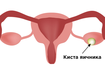 Киста яичника
