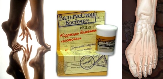 Вальгусстоп