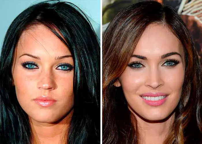 Пластическая операция по удалению комков Биша